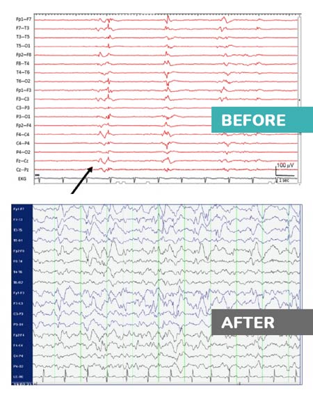 EEG